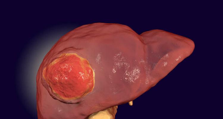 揭秘肝硬化早期的3大症状（了解早期肝硬化的关键信号）